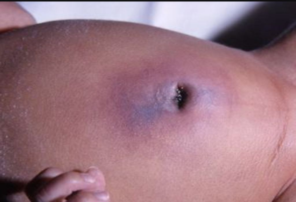 Omphalitis