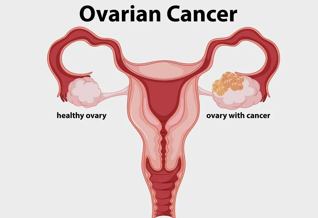 Can You Get Pregnant With One Ovary?