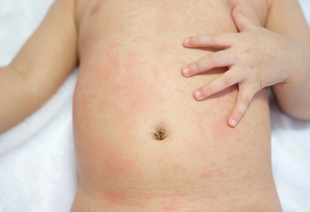 check for rash on your newborn baby