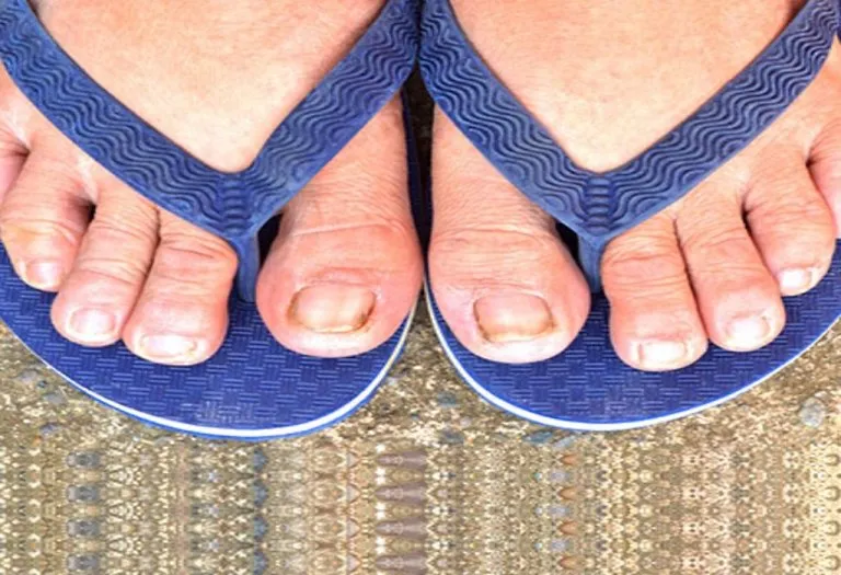 Fungal Nail Infection in Children - Causes, Symptoms, and Treatment