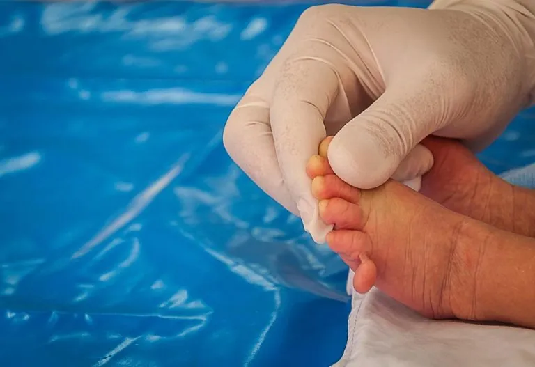 Polydactyly (Born With Extra Fingers and Toes) - Causes & Treatments