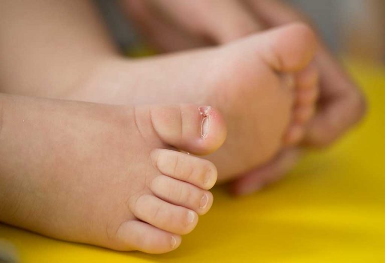 Ingrown Toenail in Children - Causes, Symptoms & Remedies