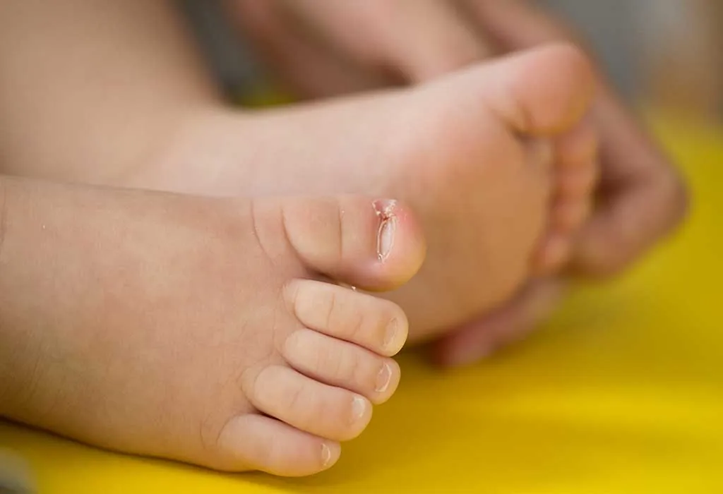 Ingrown Toenail in Infants & Children: Causes, Symptoms & Treatment