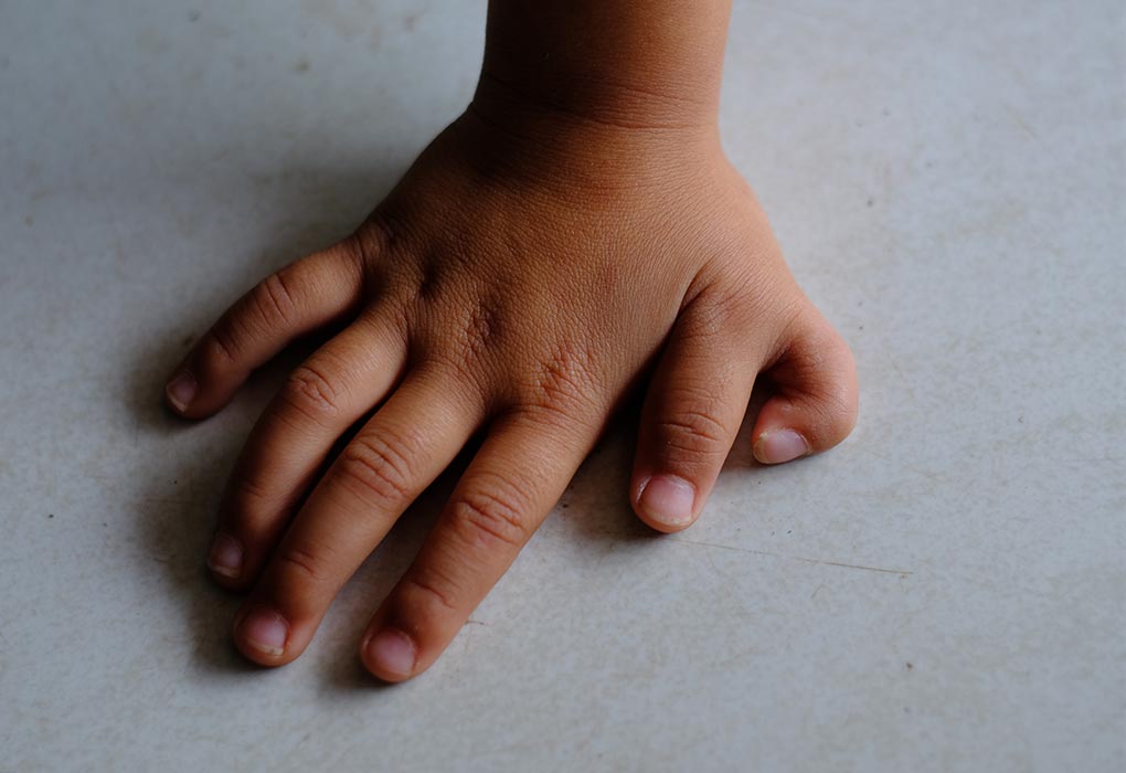 babies-born-with-extra-fingers-and-toes-causes-treatment