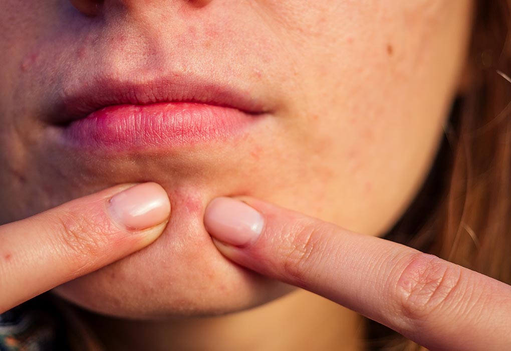 Small Red Dots On Face During Pregnancy