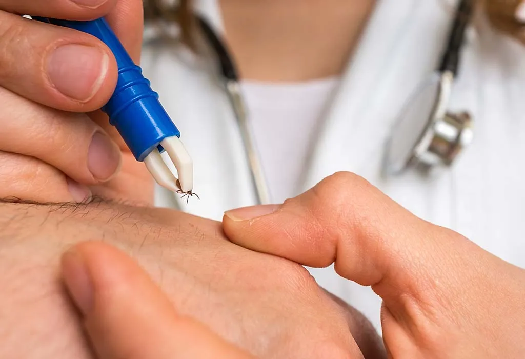 how to remove ticks from child's body