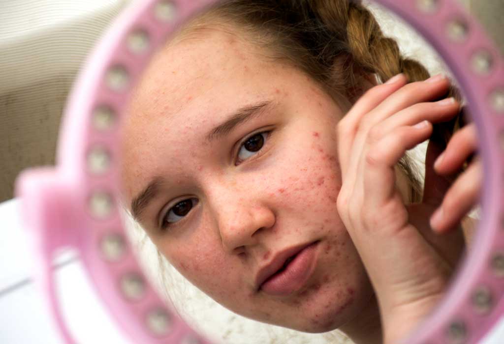 Acne in Children – Causes, Signs, and Treatment