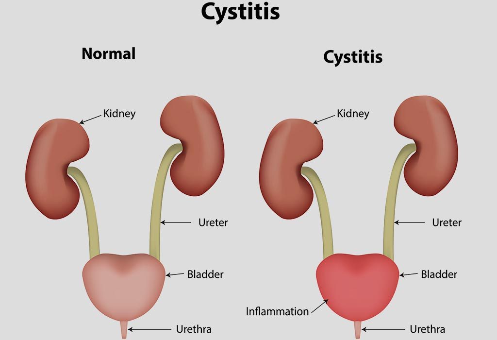 Leukocytes In Urine Causes 0962