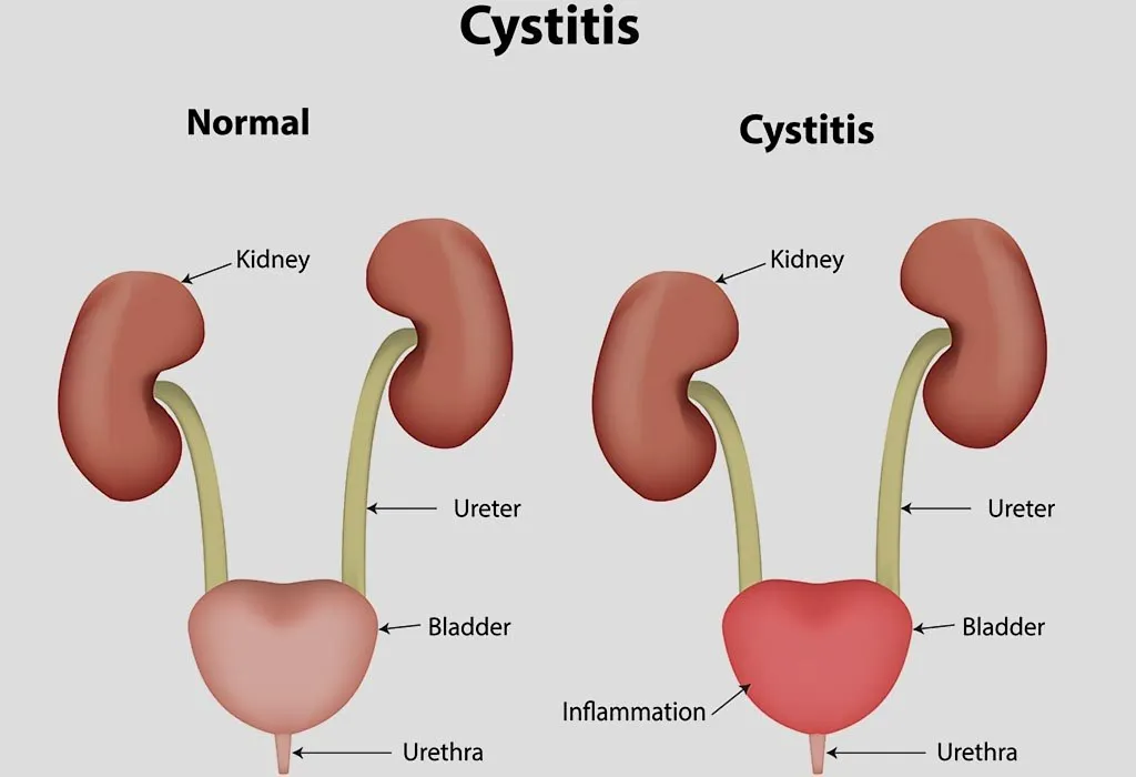 Leukocytes in Urine While Pregnant: Causes & Treatment