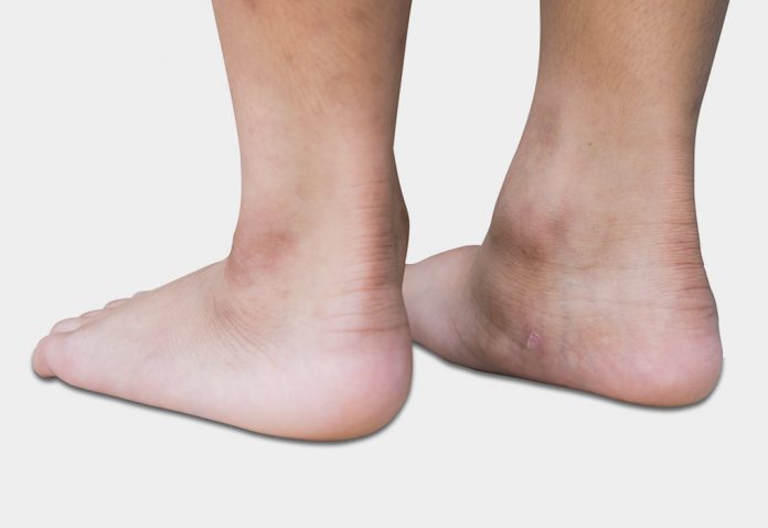 Flat foot in hindi sale