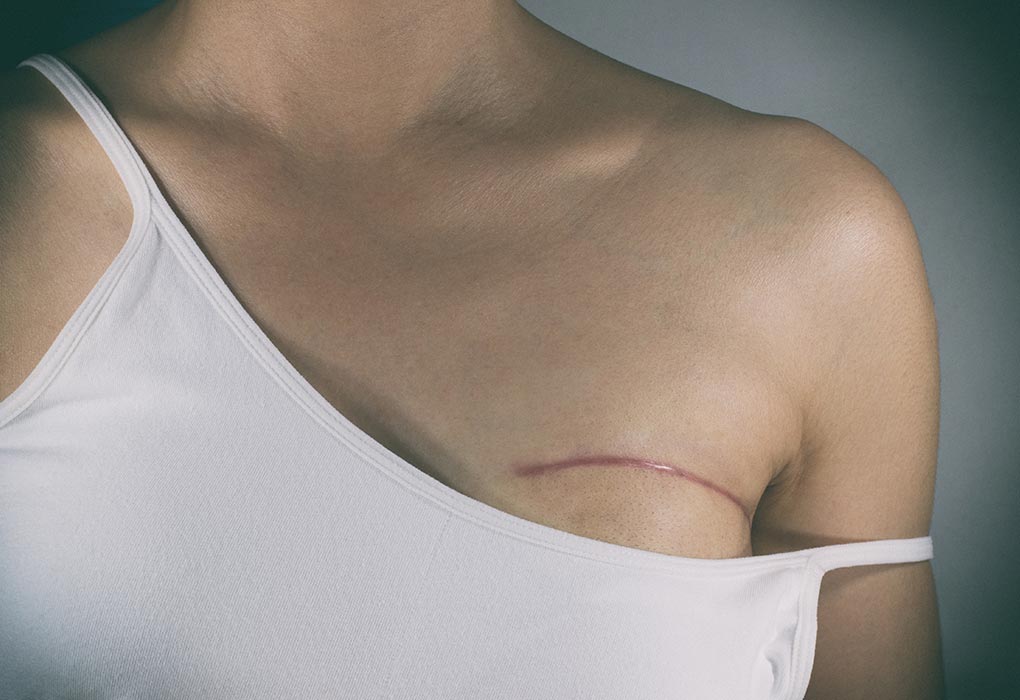 A woman who underwent a mastectomy