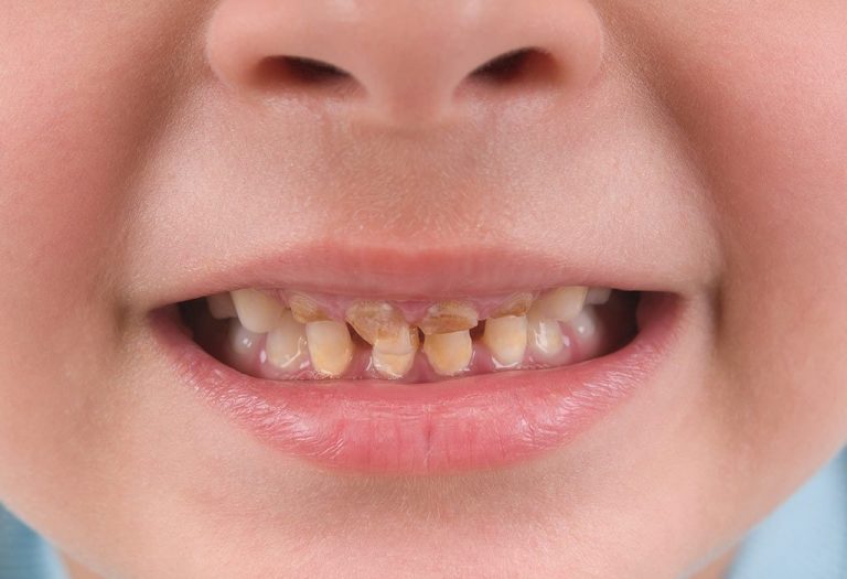 Yellow and Other Discolored Teeth in Children - Causes, Symptoms and Treatment