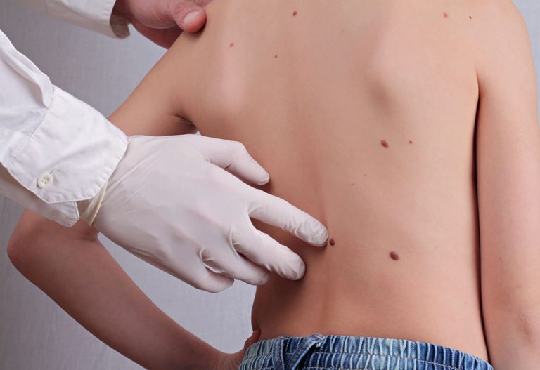 Skin Tags in Children – Causes and Treatment