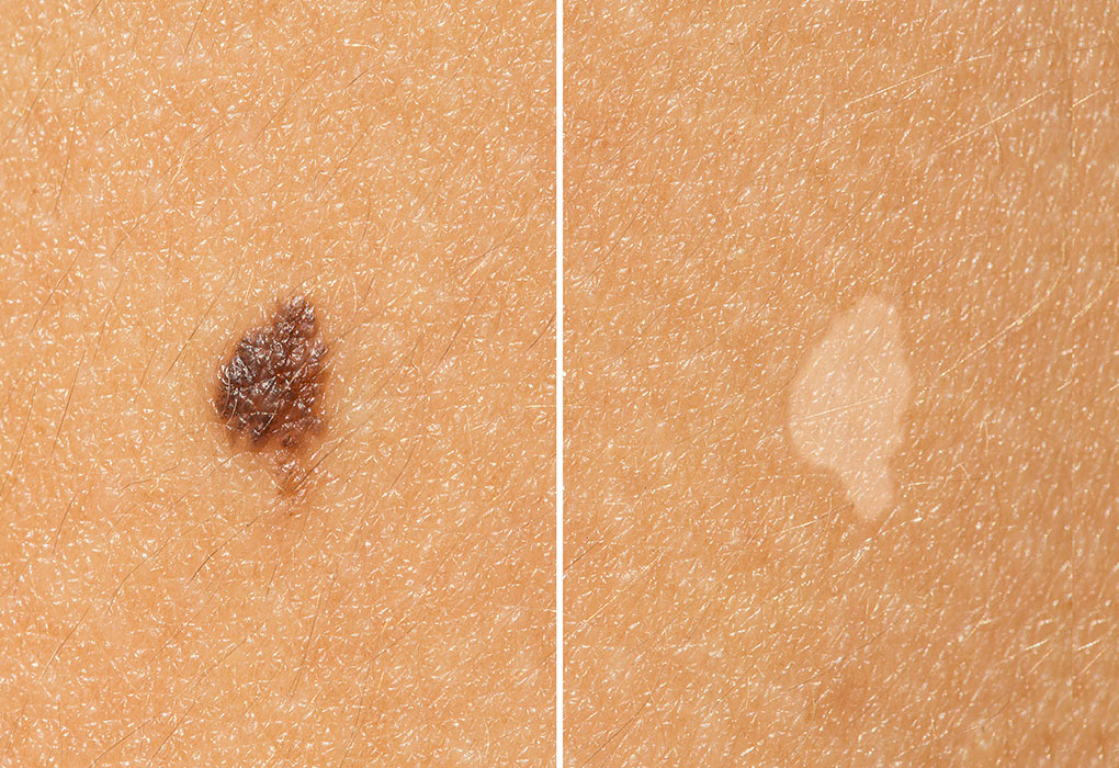 Skin tag removal - before and after