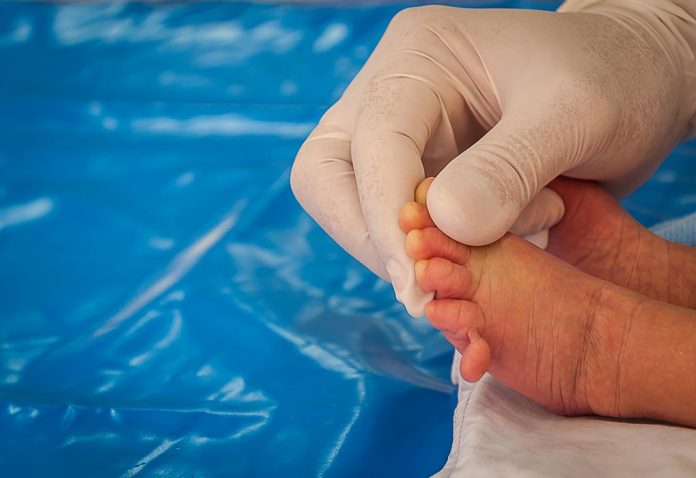 Baby Born With Extra Finger and Toes (Polydactyly)