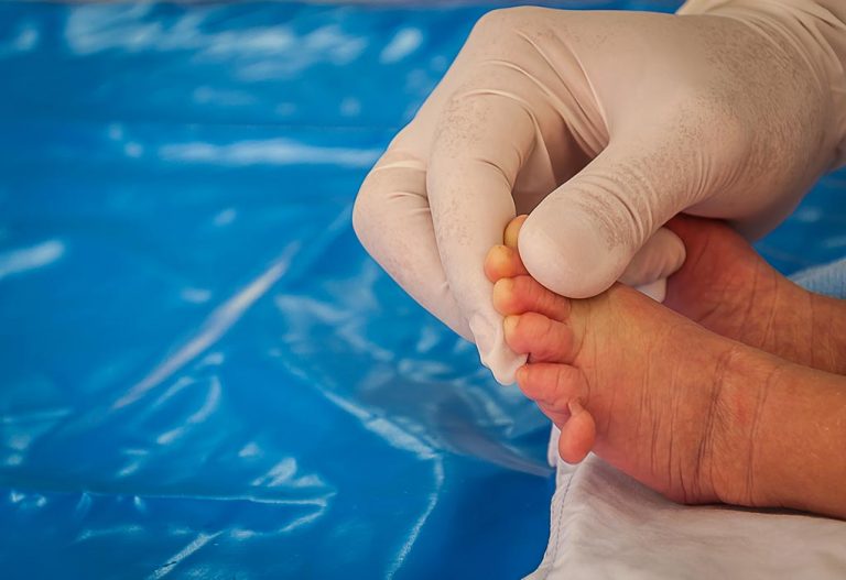 Baby Born With Extra Fingers and Toes (Polydactyly)
