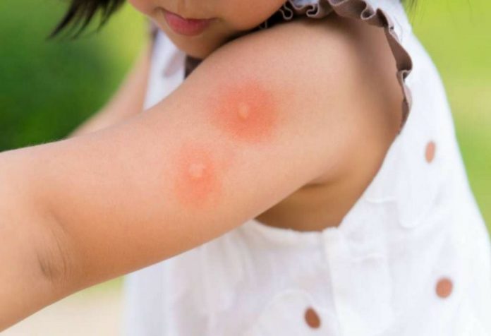 4 times of the day when kids are at maximum risk of mosquito borne diseases2