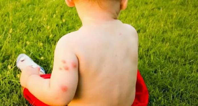 5 Möglichkeiten, wie durch Mücken übertragene Krankheiten die allgemeine Entwicklung Ihres Kindes beeinträchtigen können 