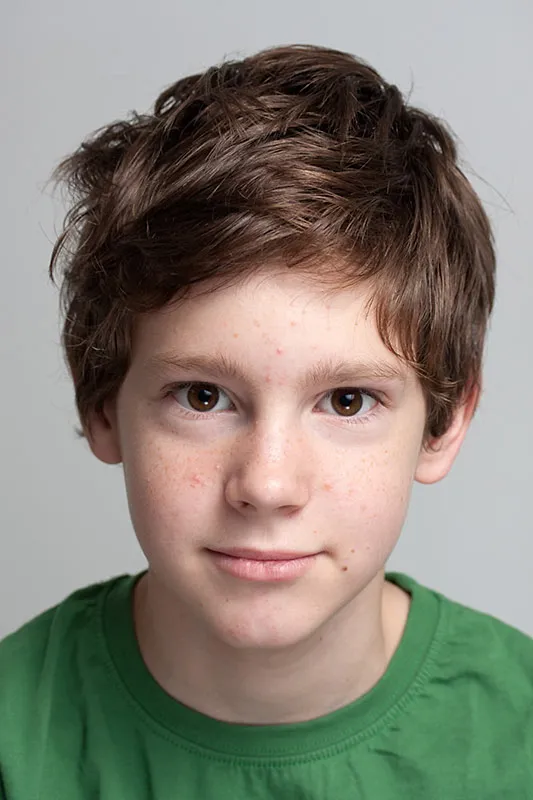 What Causes Acne in Kids?