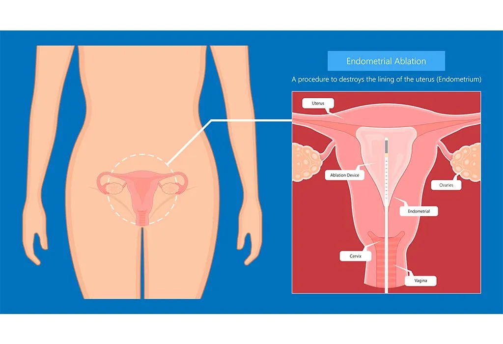 Chances of Pregnancy Post Endometrial Ablation