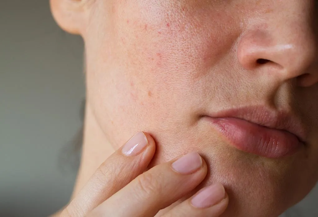 Top 15 Home Remedies to Cure Open Pores on Face & Skin