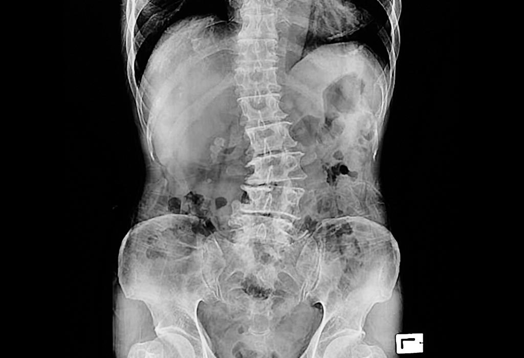 X-ray to check for scoliosis