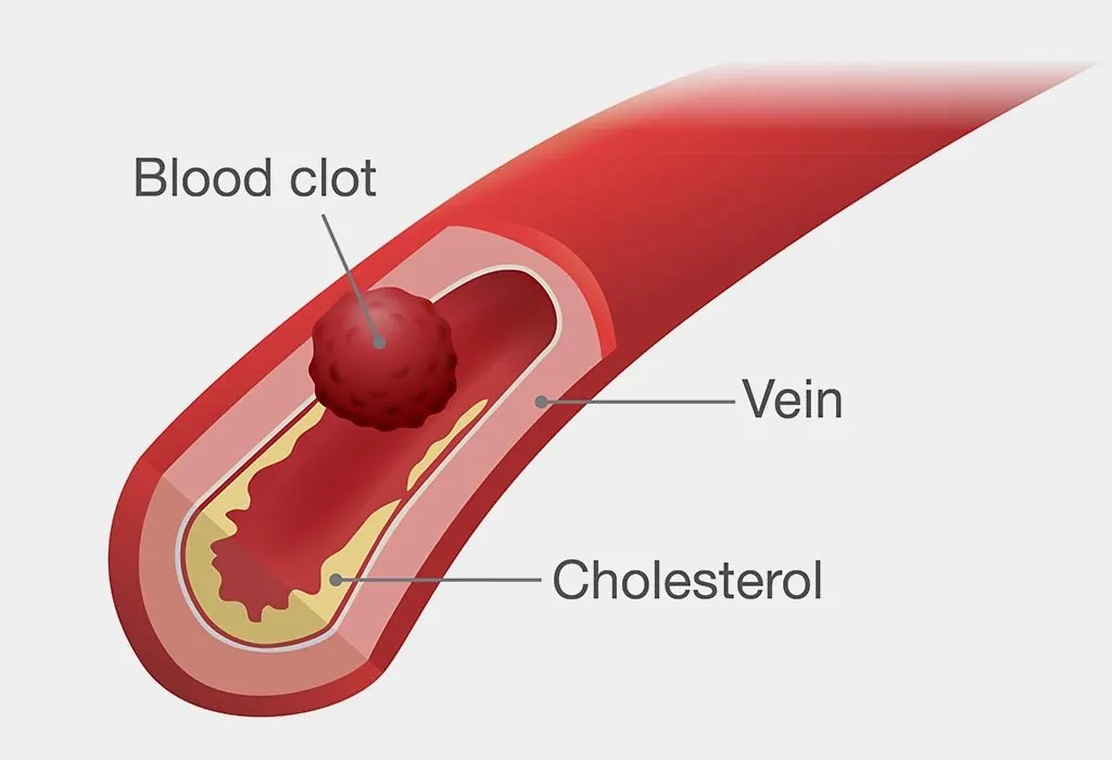 Blood clots
