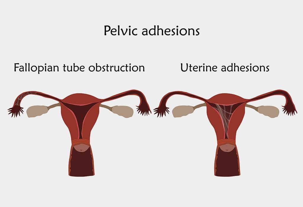 Pelvic adhesions