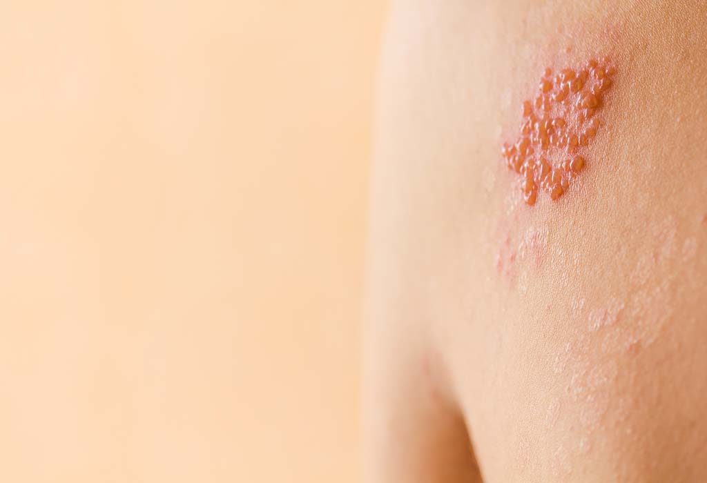 Shingles In Kids Causes Symptoms Treatment Prevention   664501366 H 1024x700 