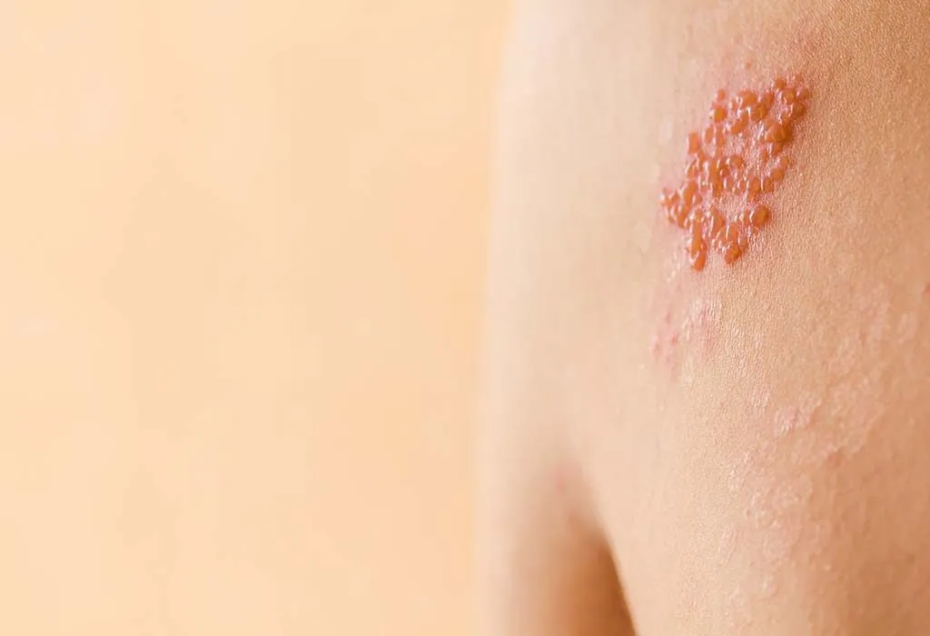 What is Shingles?