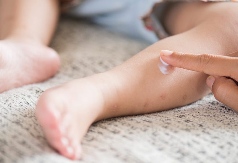 Calamine Lotion for Babies - Benefits, Side-effects and Precautions