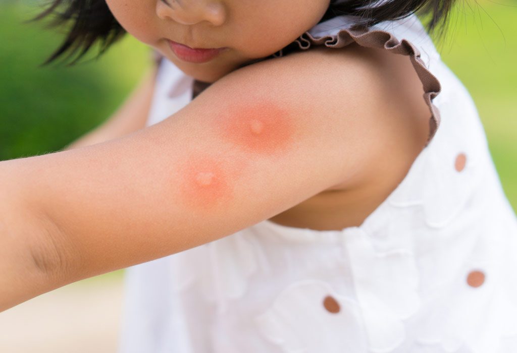 A baby with insect bites on her arm