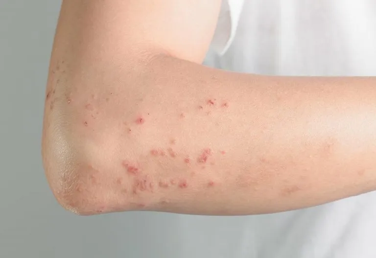 Postpartum Hives - Causes and Treatment
