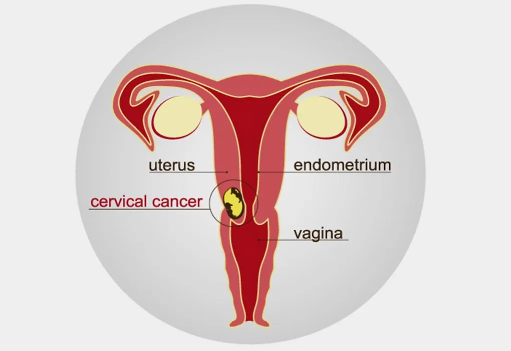 Cervical cancer