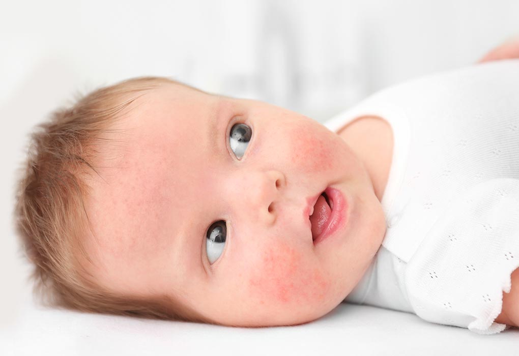 A baking soda bath helps to manage baby eczema