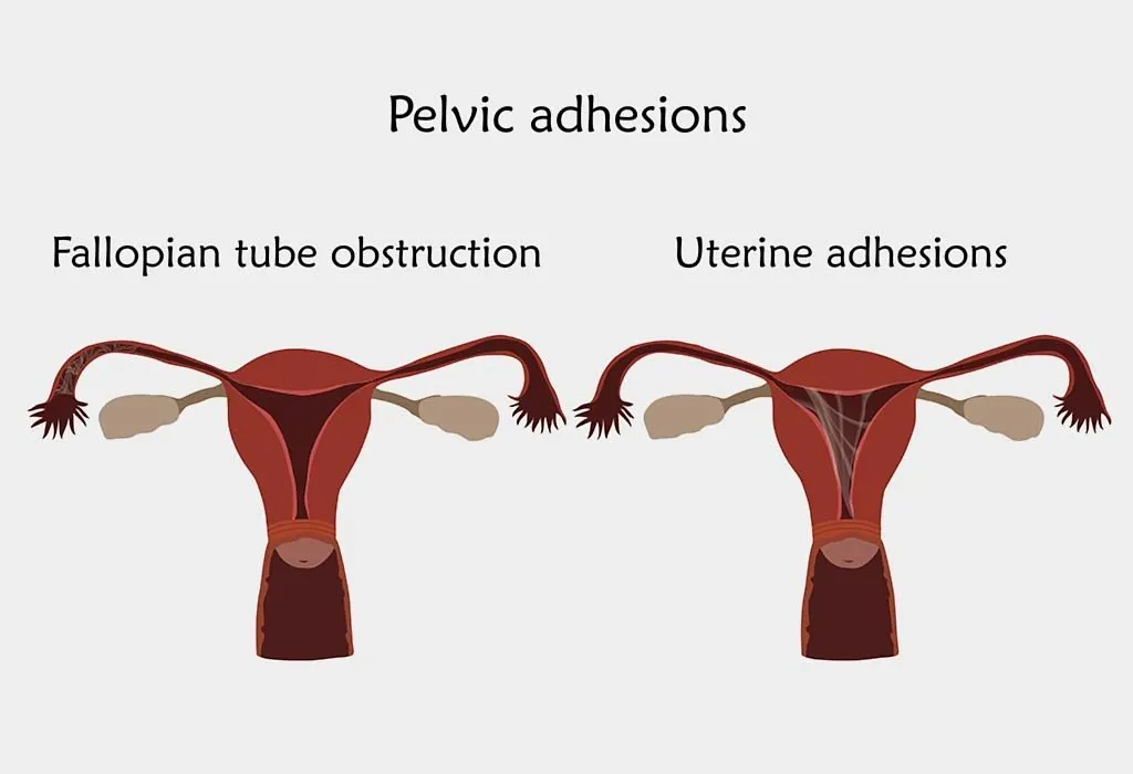 Pelvic adhesions