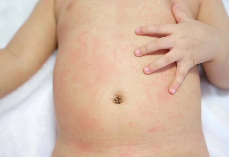 Rashes! A Big Concern. Say No to Rashes Forever and Be a Super Mom.