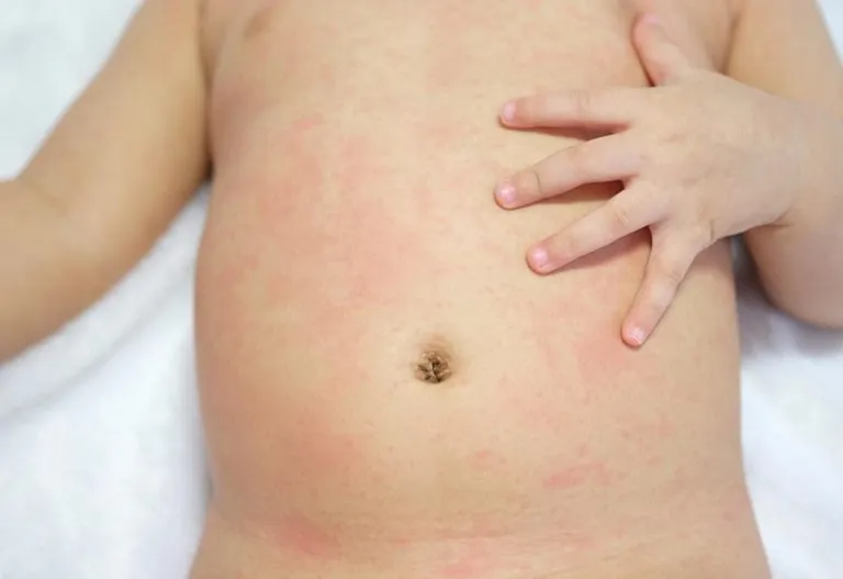 Rashes! A Big Concern. Say No to Rashes Forever and Be a Super Mom.