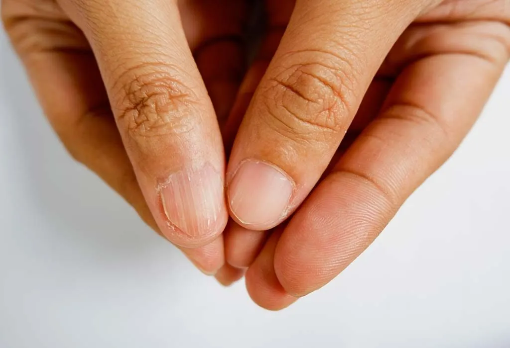 A woman with brittle nails