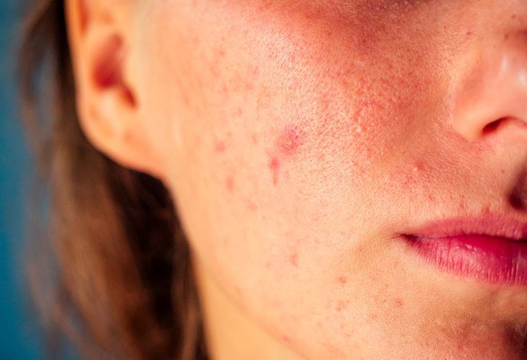 anti-androgen medication helps reduce acne