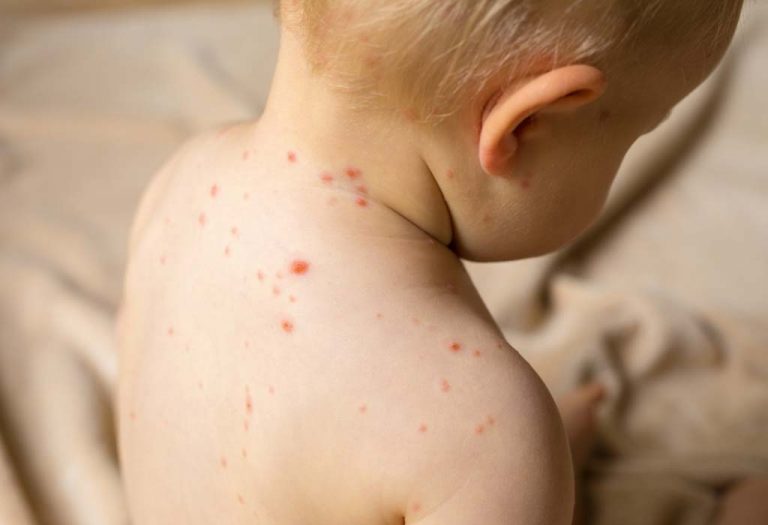10 Effective Home Treatments for Chickenpox