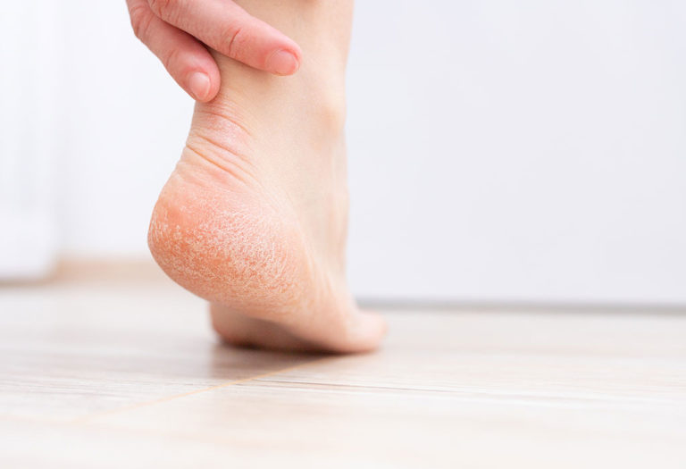 20 Simple and Effective Home Remedies for Cracked Heels