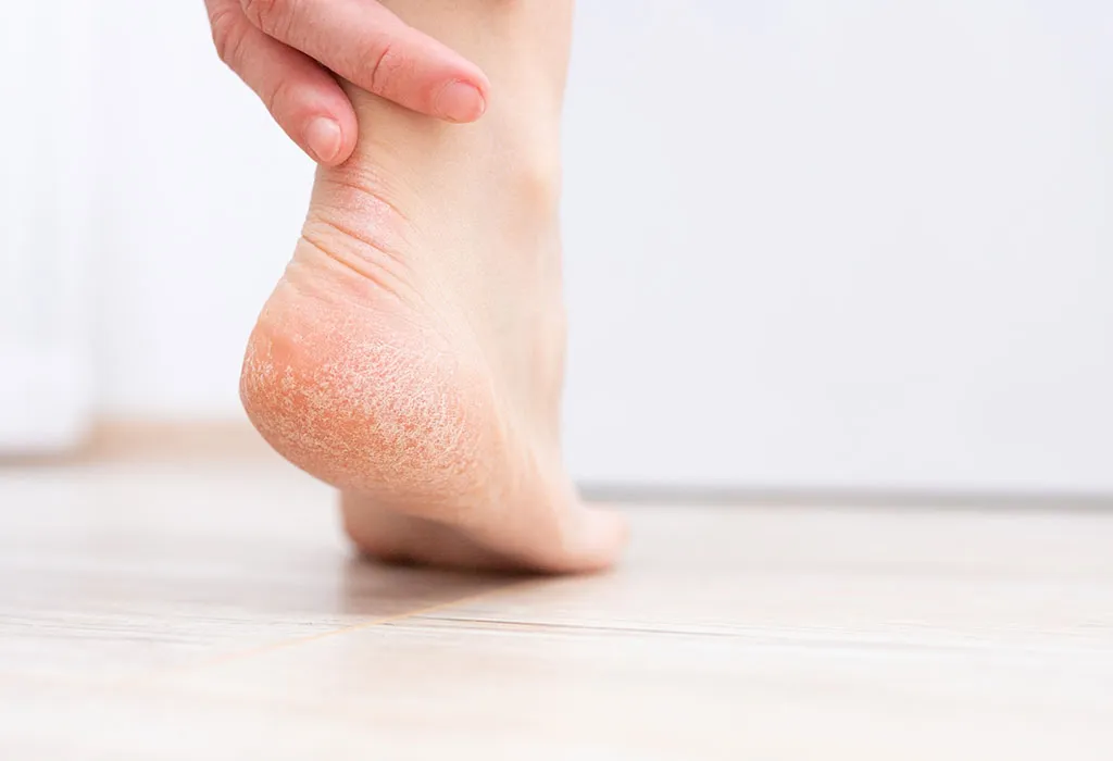 The Cost of Cracked Heels - Health First Foot and Gait Clinic