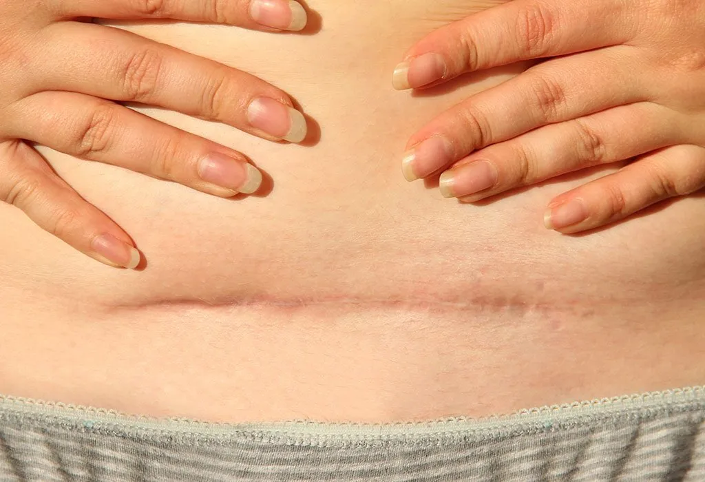 gestational diabetes can call the need for a c-section