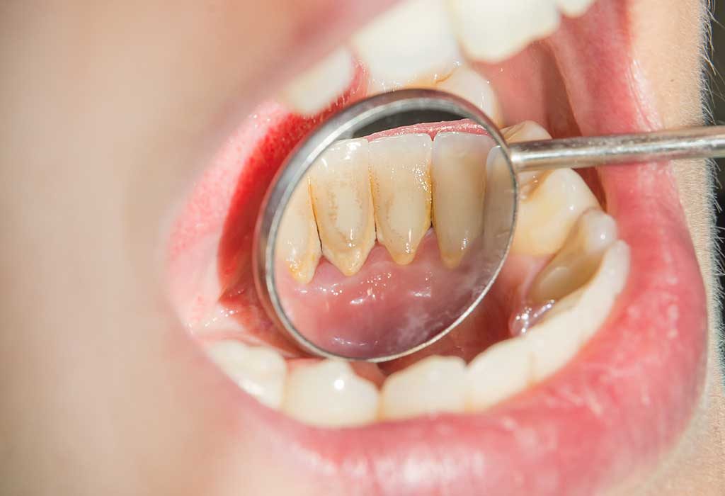 Oral Plaque