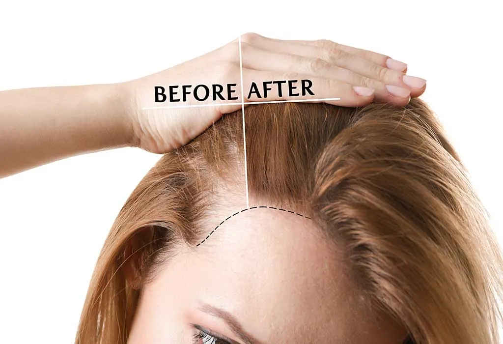 Hair Loss