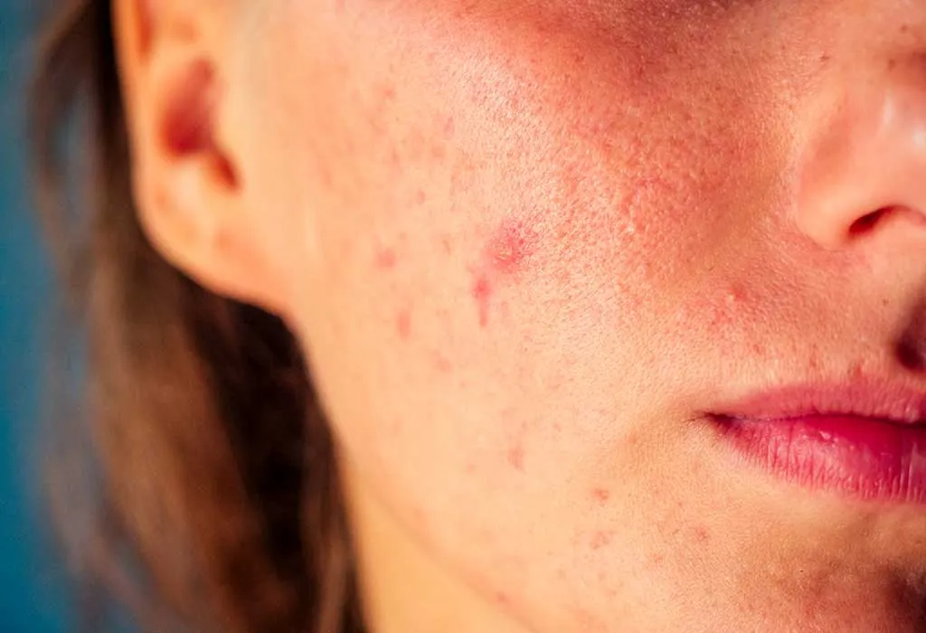 Acne