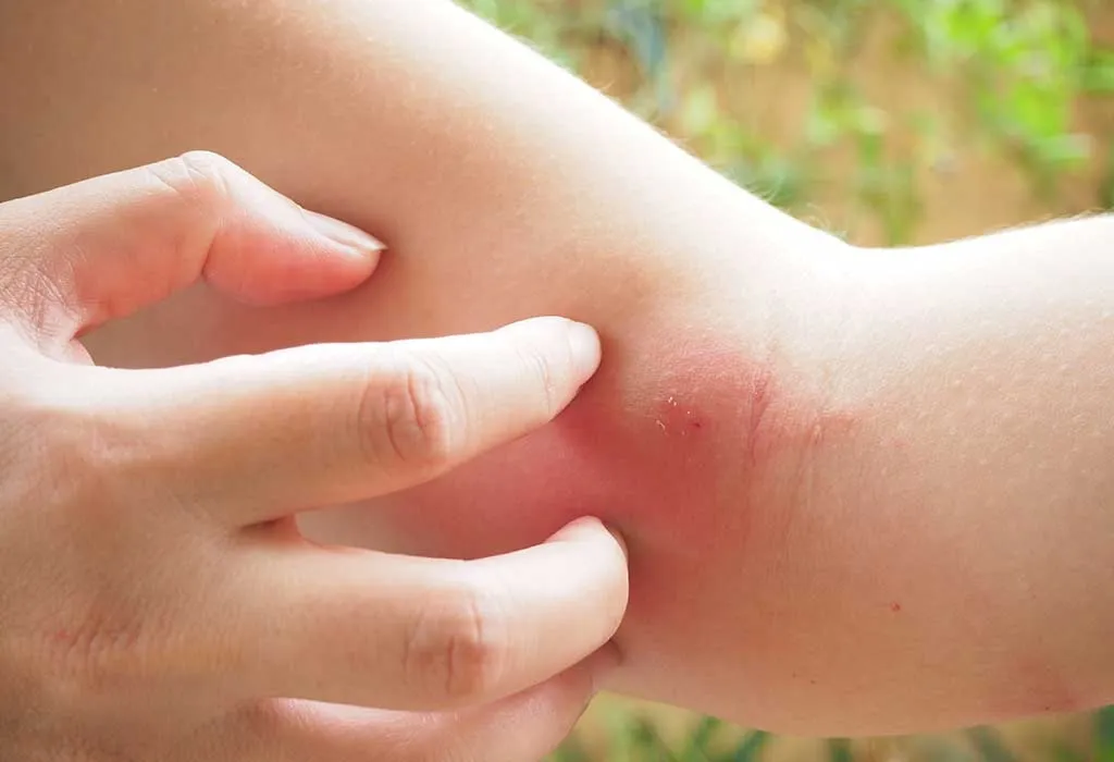 Insect Bites