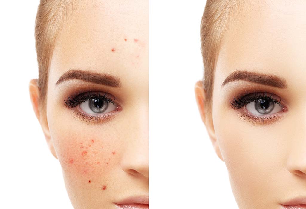 10 Working Home Remedies For Skin Pigmentation