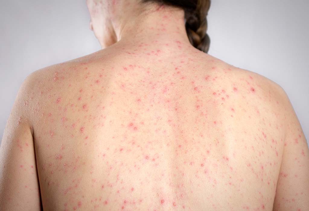 Chickenpox While Breastfeeding – Treatment and Precautionary Tips